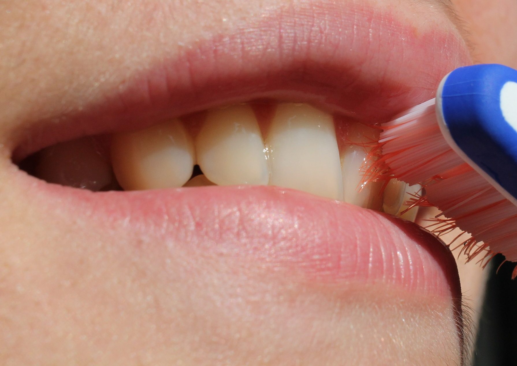 Le brossage des dents avec un appareil orthodontique - Orthonys
